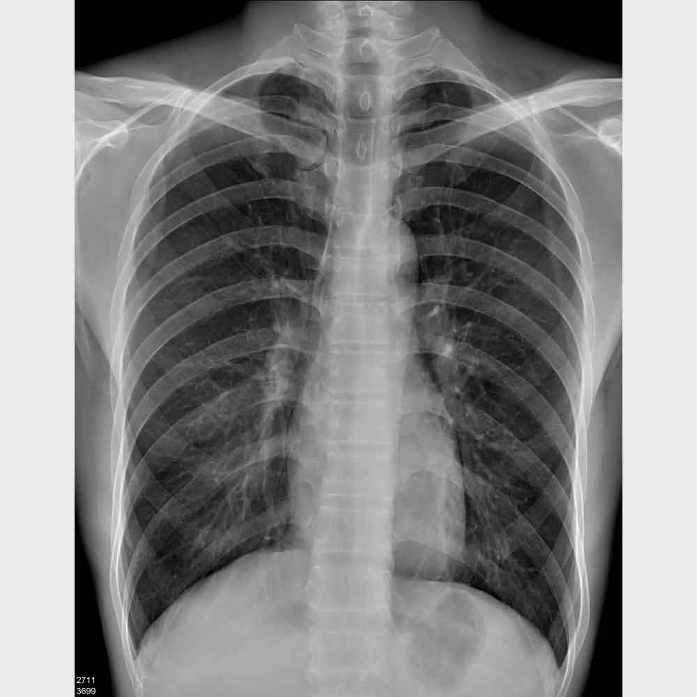 Medical Dry Film HSIN FILM