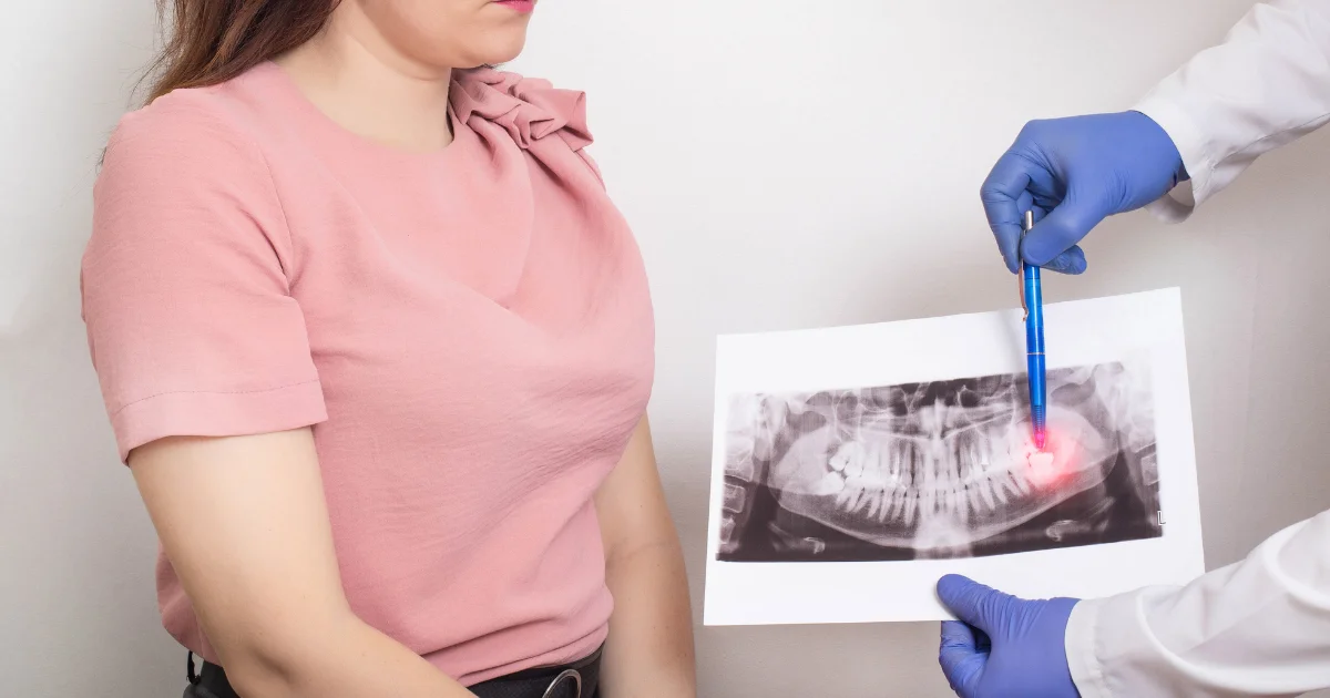 Discover Wisdom Teeth on X-Rays - HSIN Film