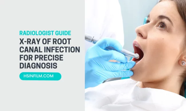 X-ray of Root Canal Infection for Precise Diagnosis – HSIN Film X-ray of Root Canal Infection for Precise Diagnosis - HSIN Film