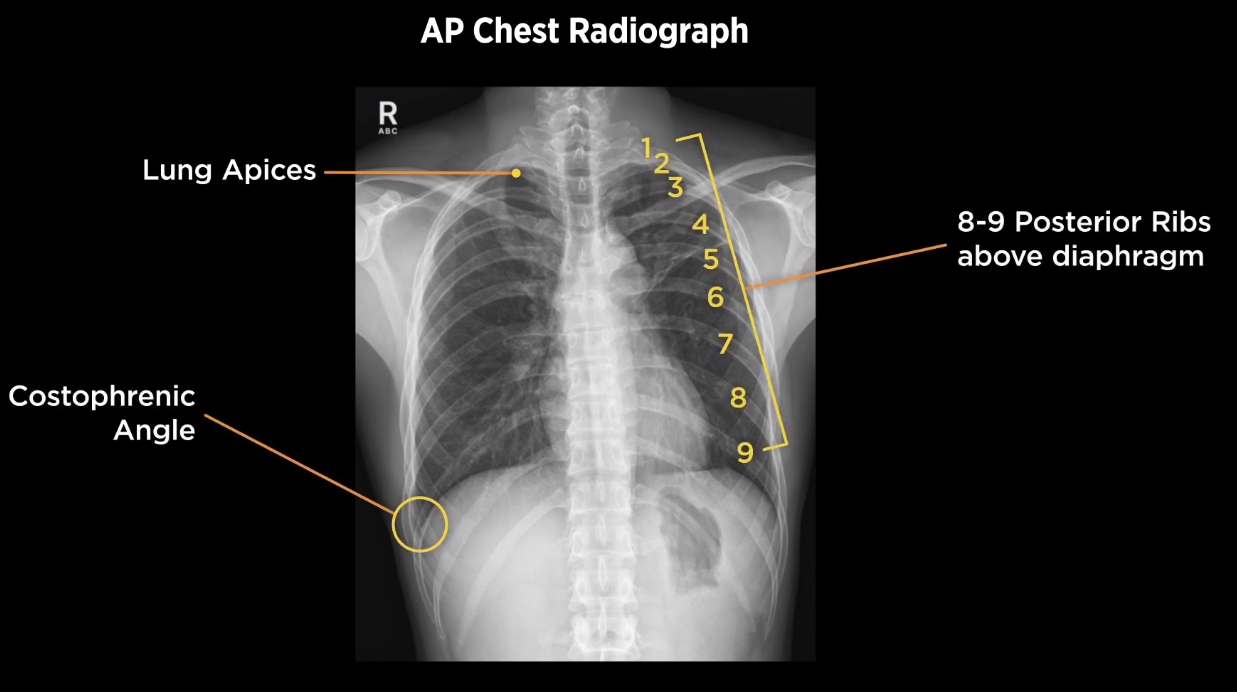 A Full Radiologist Guide on Lordotic Chest X-ray - HSIN FILM