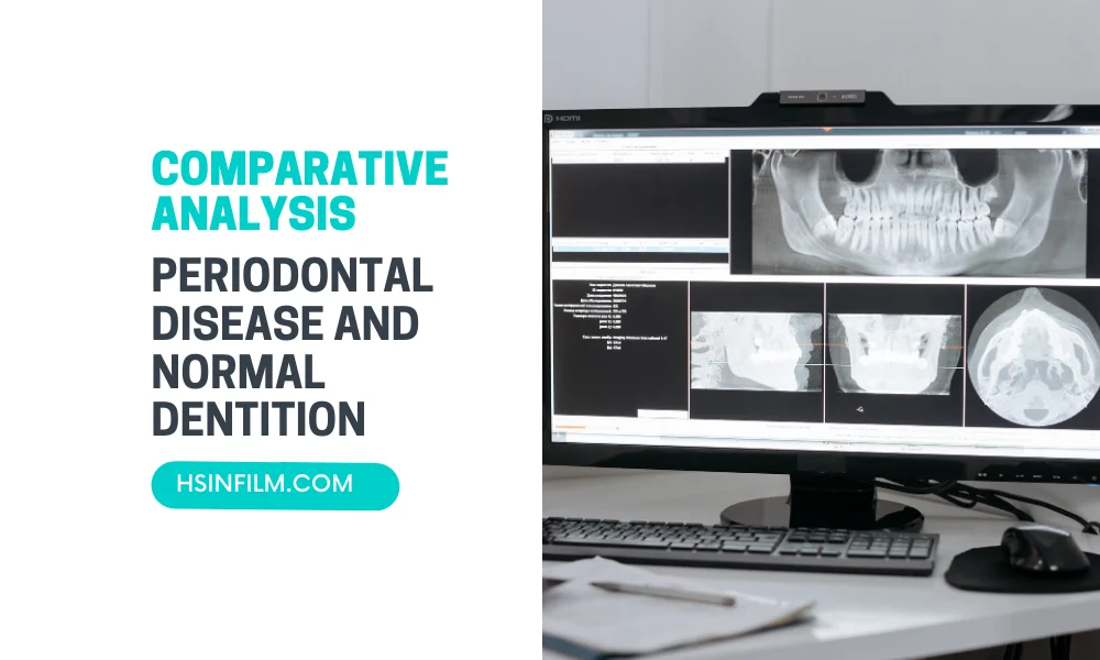 A Comparative Analysis of X-rays in Periodontal Disease and Normal Dentition