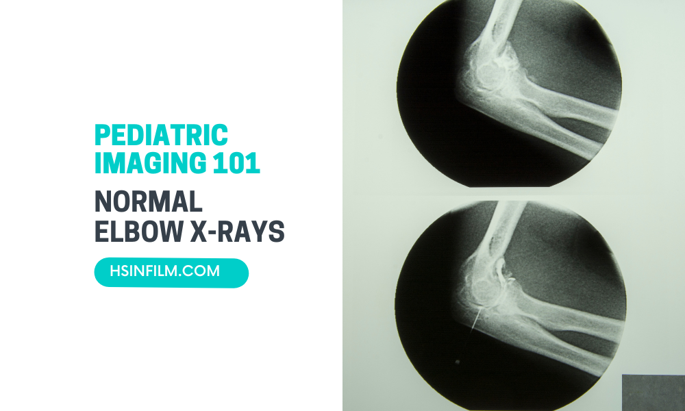 Normal Pediatric Elbow X-rays Radiography 101