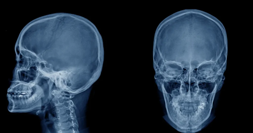 How Do Lateral Skull X-rays Contribute to Patient Care