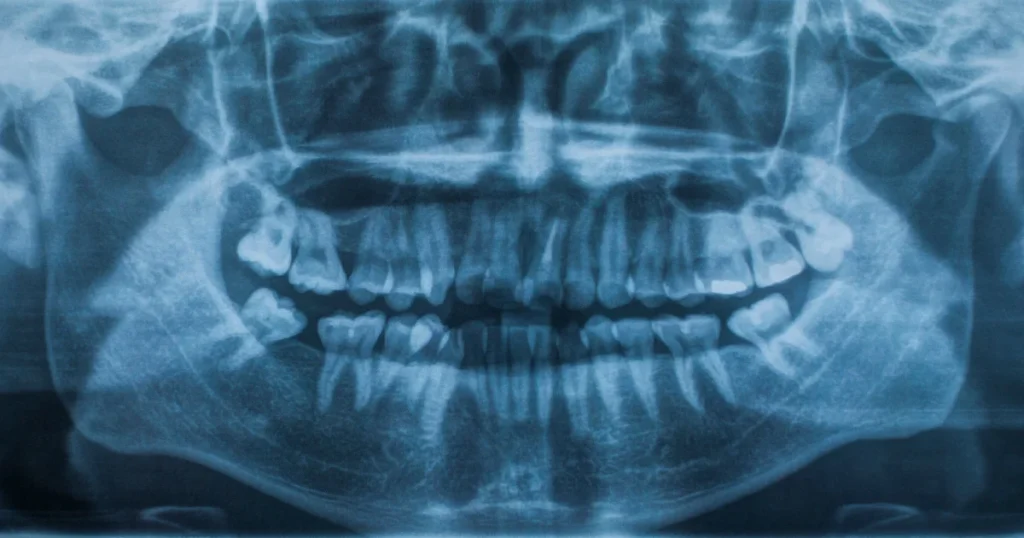 Understanding Panoramic X-ray Anatomy