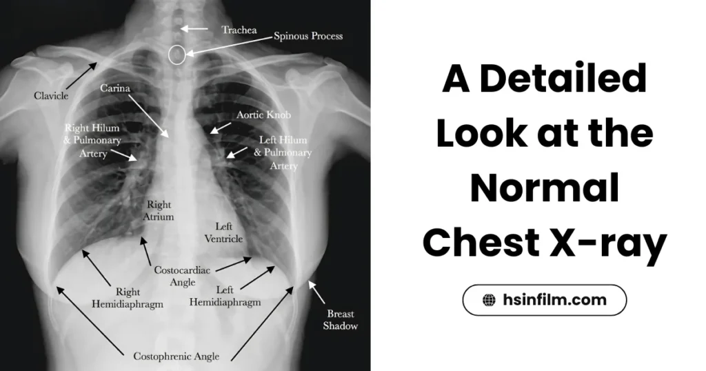 A Detailed Look at the Normal Chest X-ray